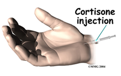 Carpal tunnel syndrome (CTS)